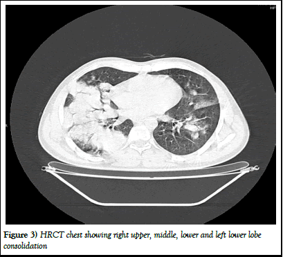 pulmtcr-x ray pulmtcr-x ray